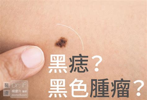 陰莖長黑痣|陰莖及陰囊上的痣：該如何處理？